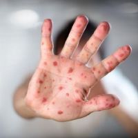 Kasus Campak Melonjak di Indonesia, Dokter Bagikan Cara Lindungi Anak dari Penularan
