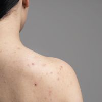 5 Cara Ampuh Atasi Jerawat Punggung, Kulit Mulus dan Makin Pede Lagi!