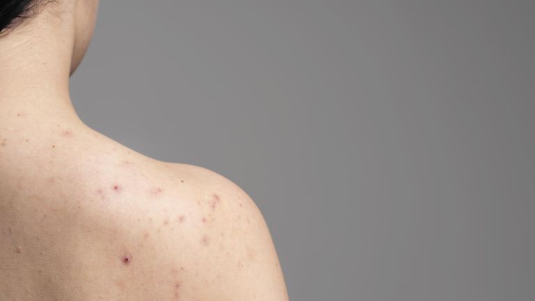 5 Cara Ampuh Atasi Jerawat Punggung, Kulit Mulus dan Makin Pede Lagi!