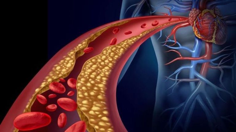 6 Cara Cegah Kolesterol Naik Usai Lebaran