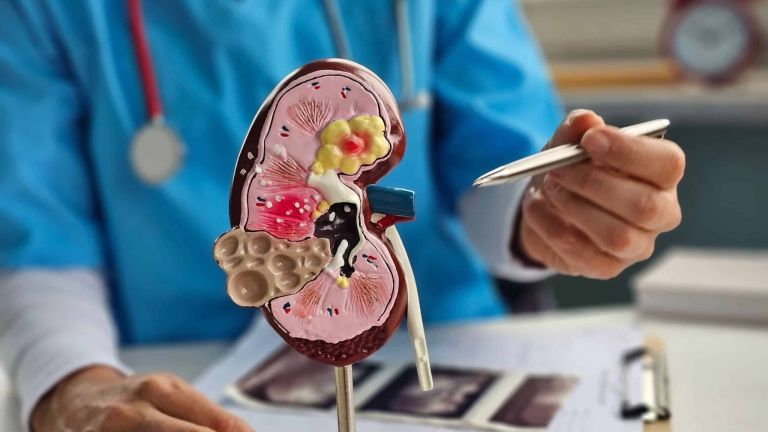 Kena Batu Ginjal, Apakah Harus Dioperasi? Ini Kata Dokter
