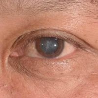 Indonesia Masuk Fase Ageing Population, Katarak Jadi Ancaman Penglihatan Lansia