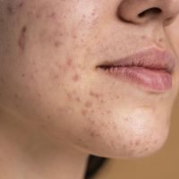 Jangan Salah Langkah! Ini Cara Mengenal Jenis Jerawat dan Skincare Routine yang Tepat
