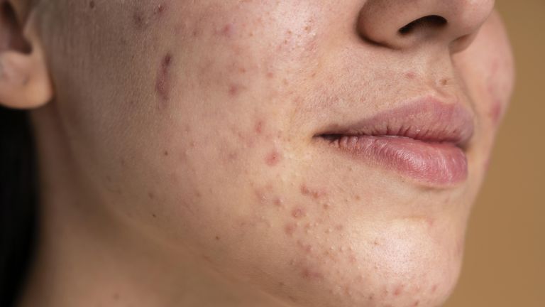 Jangan Salah Langkah! Ini Cara Mengenal Jenis Jerawat dan Skincare Routine yang Tepat